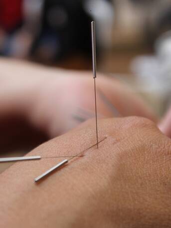 Acupuncture needles in hand