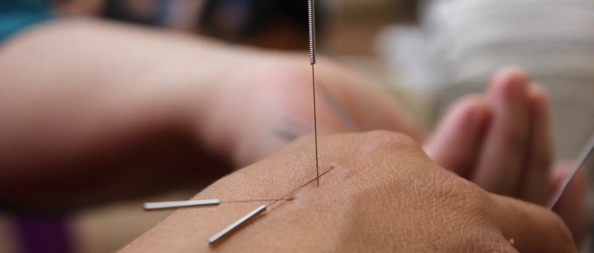 Acupuncture needles in hand