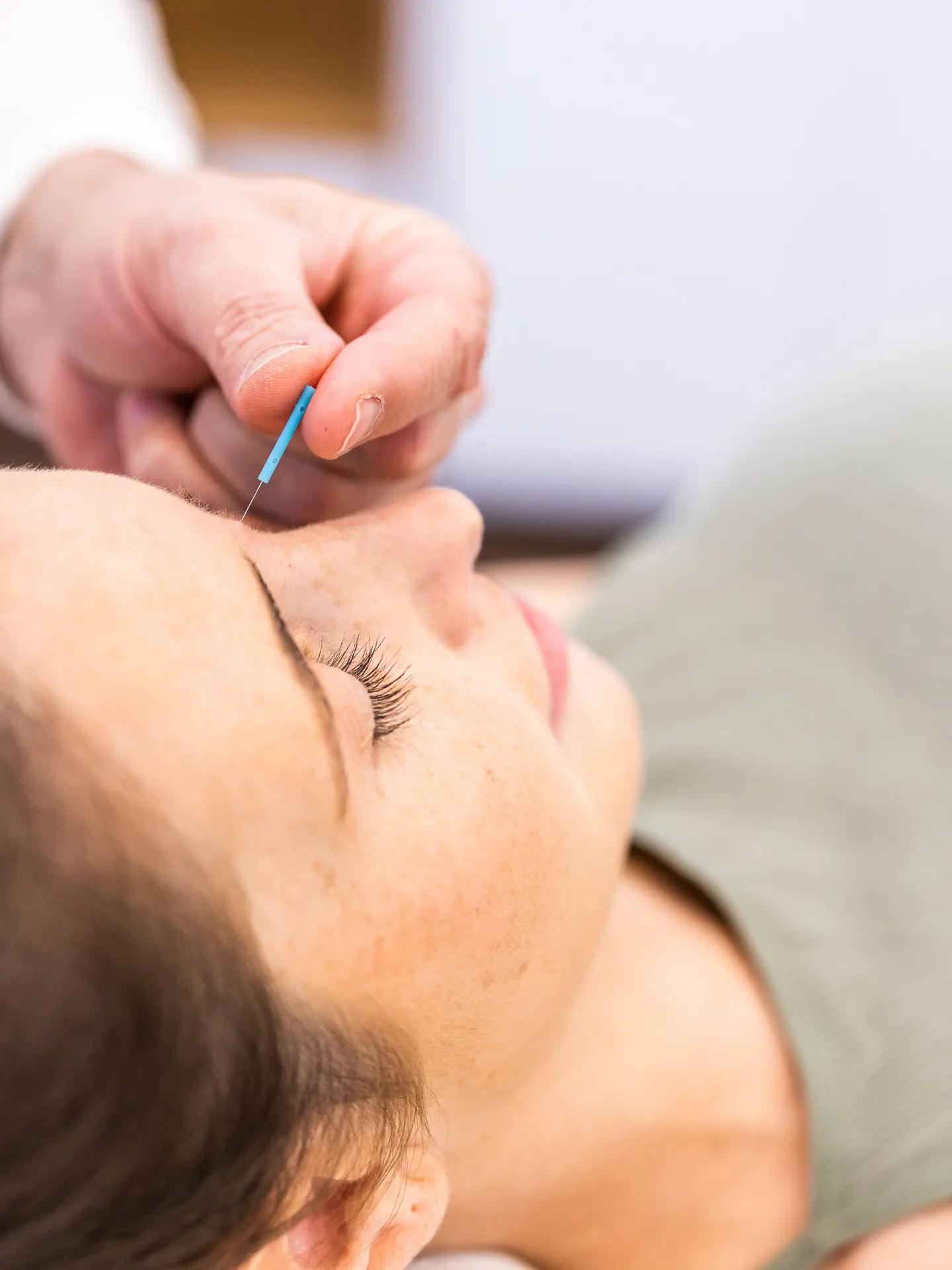 Acupuncture treatment